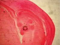 Taenia solium