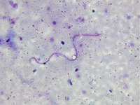 Wuchereria bancrofti