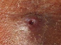 Dermatobia hominis - Human bot fly